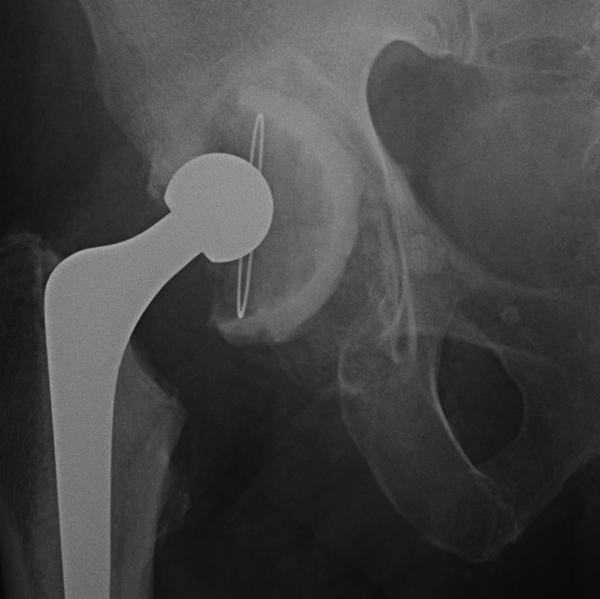 Revision THR Type IIC Acetabulum